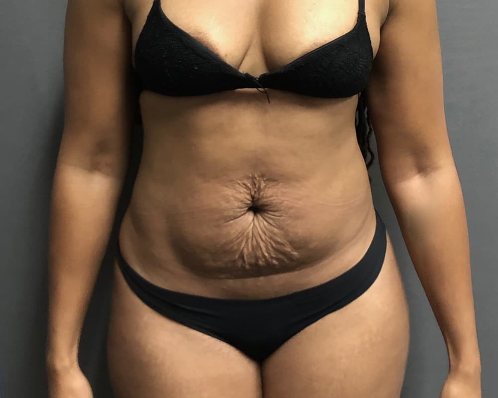 Tummy Tuck Before & After Image