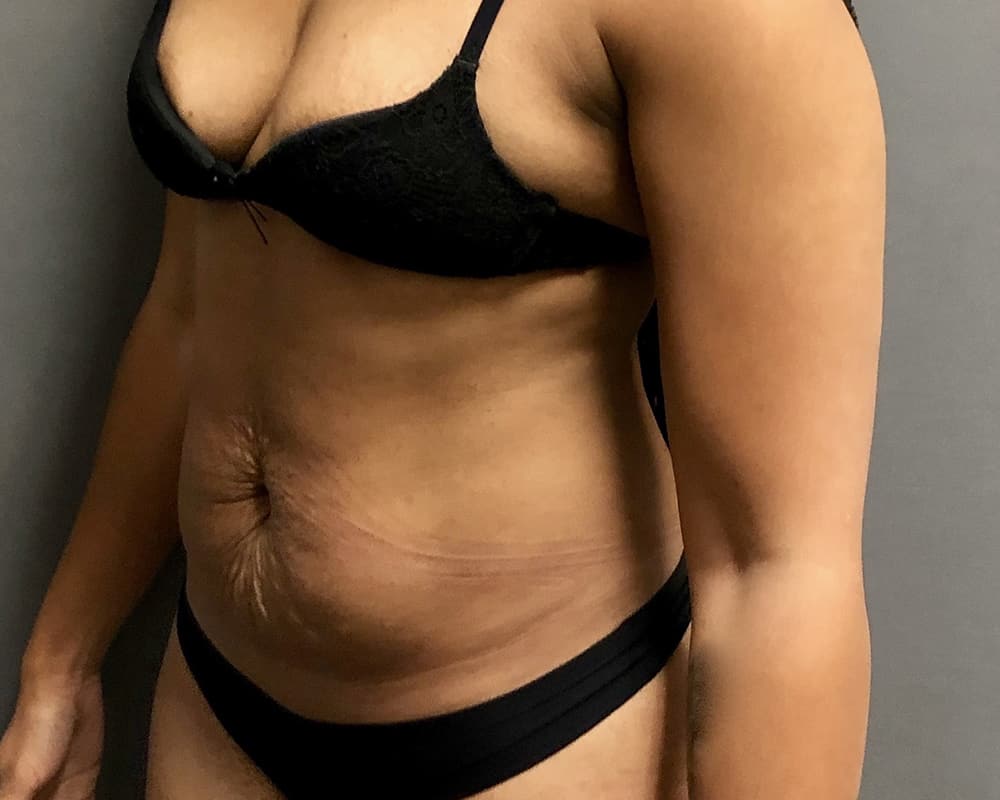 Tummy Tuck Before & After Image