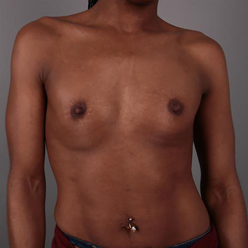 Breast Augmentation Before & After Image