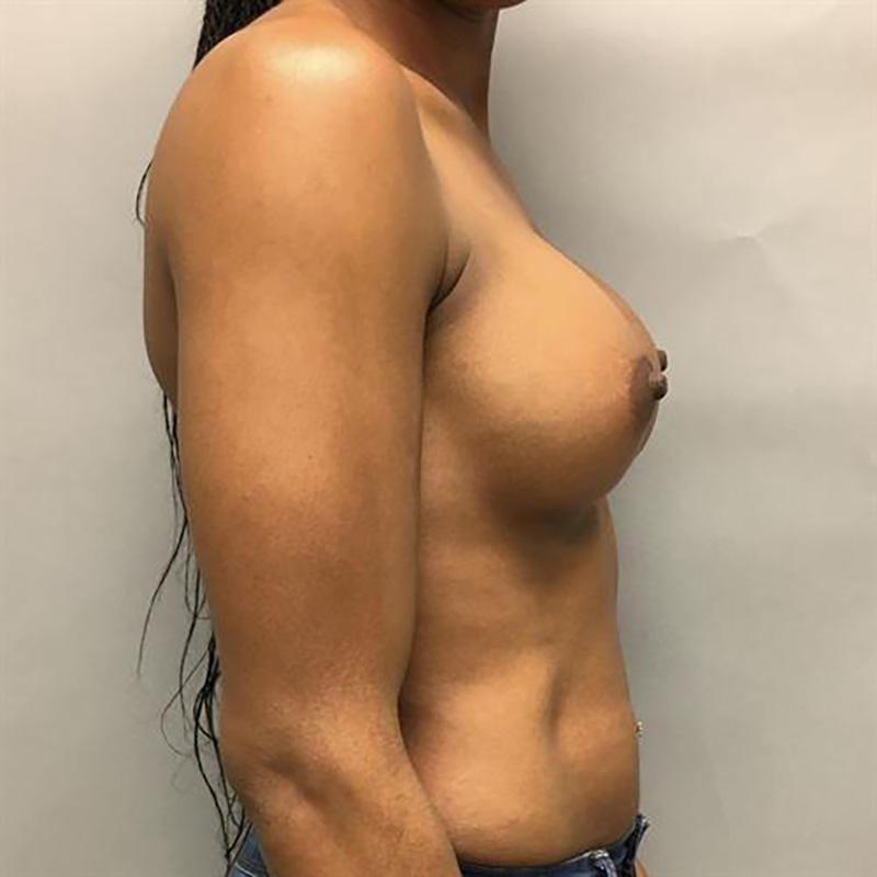 Breast Augmentation Before & After Image