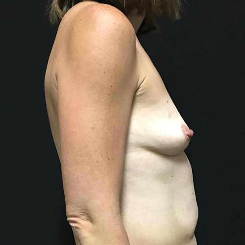 Breast Augmentation Before & After Image