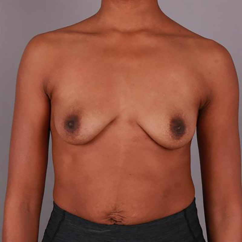 Breast Augmentation Before & After Image