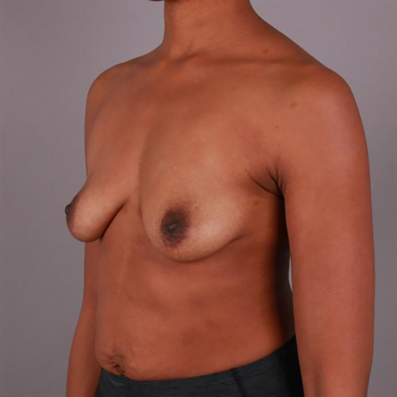 Breast Augmentation Before & After Image