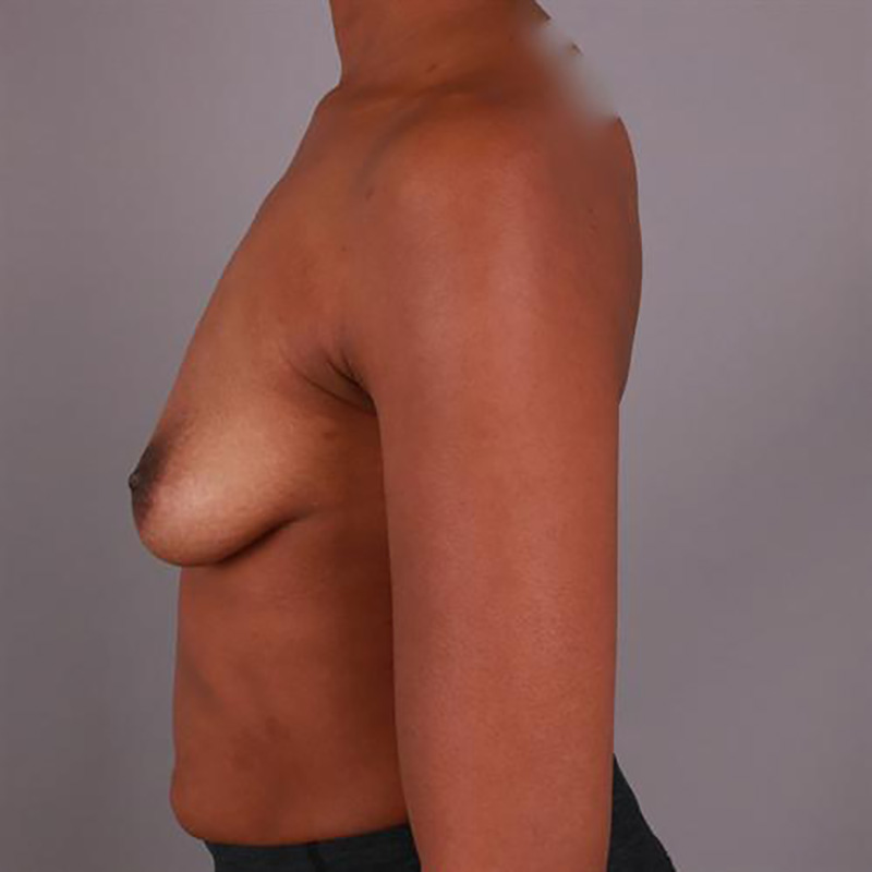 Breast Augmentation Before & After Image