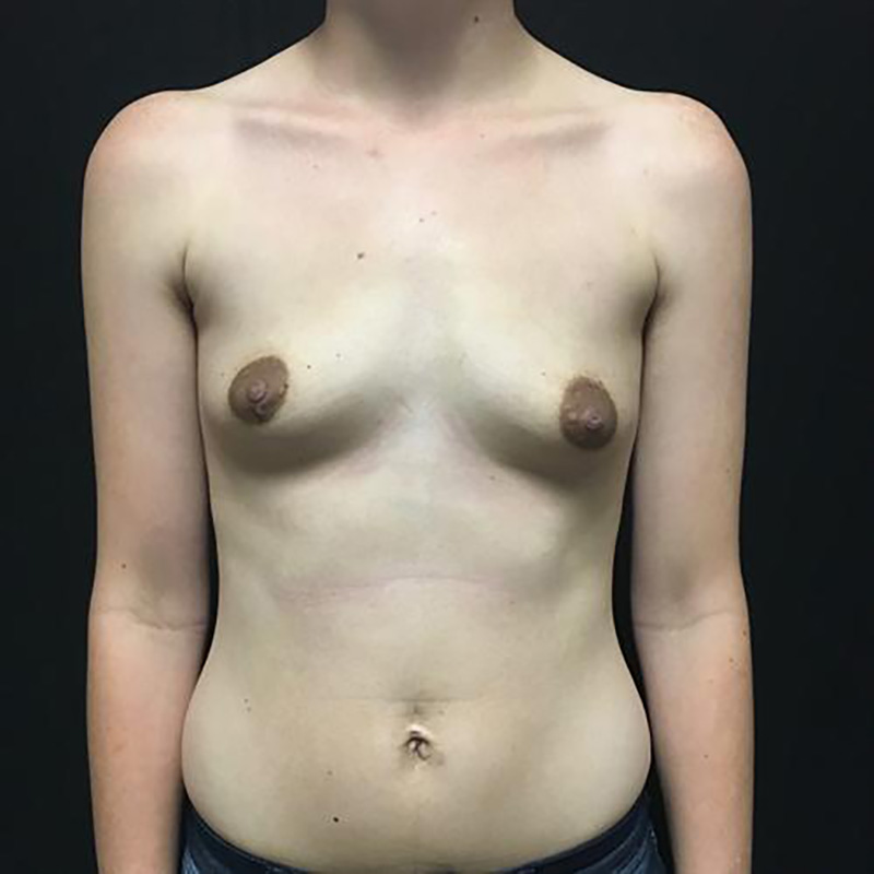 Breast Augmentation Before & After Image