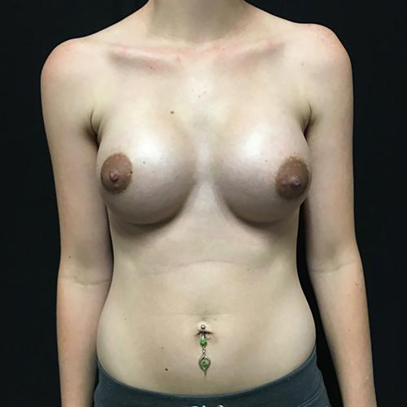 Breast Augmentation Before & After Image