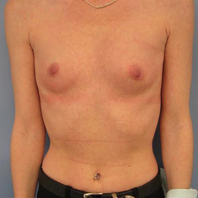 Breast Augmentation Before & After Image