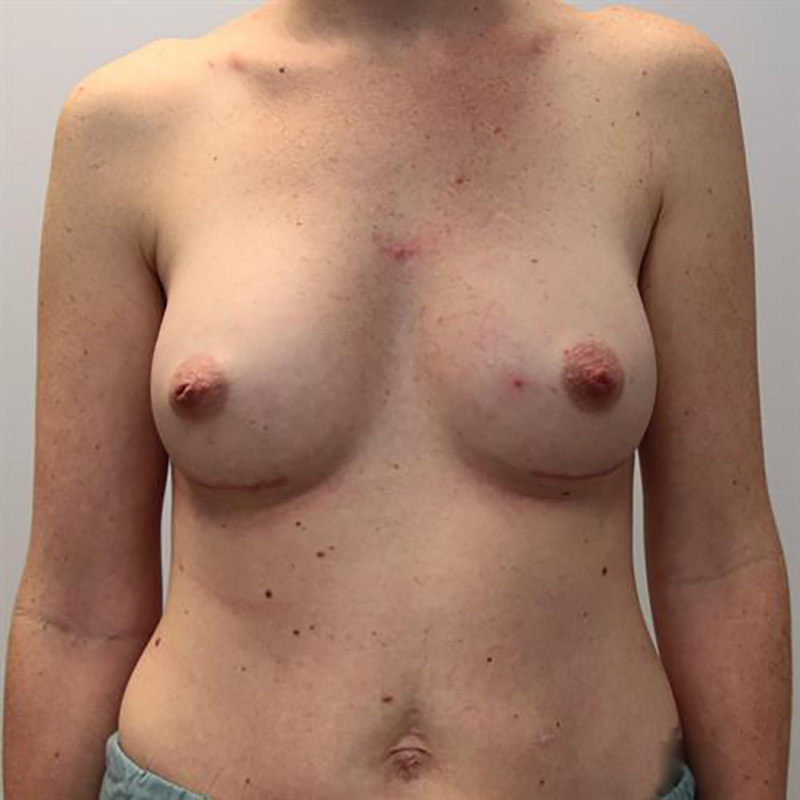 Breast Augmentation Before & After Image