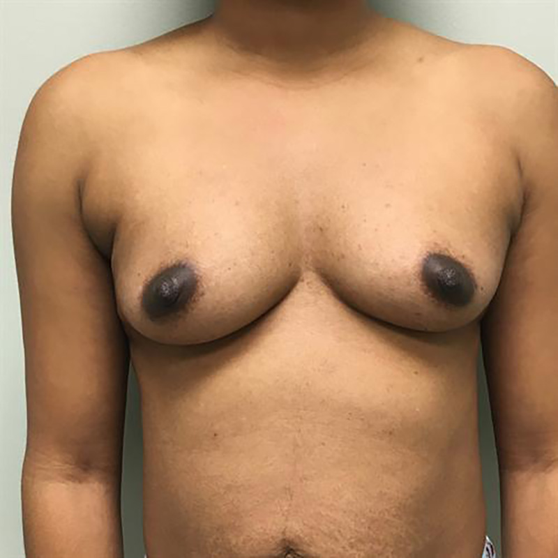 Breast Augmentation Before & After Image