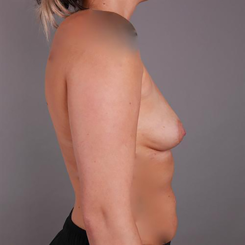 Breast Augmentation Before & After Image