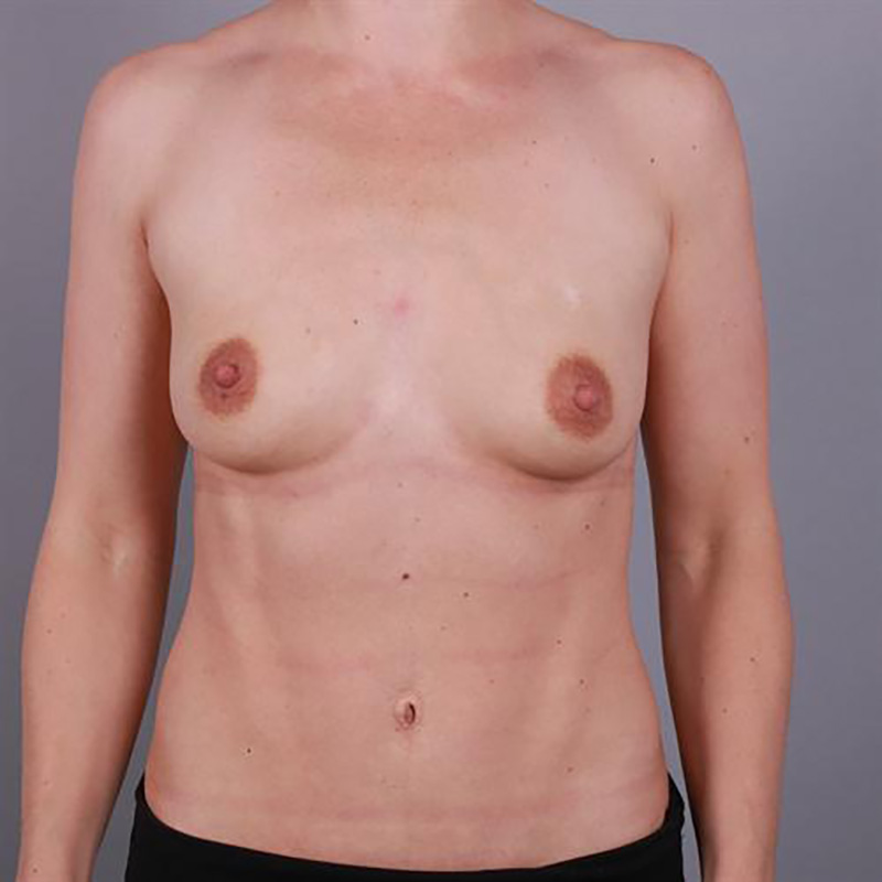 Breast Augmentation Before & After Image