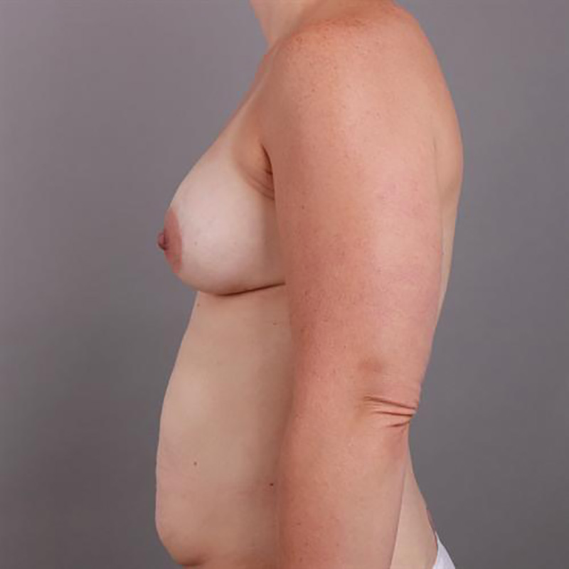 Breast Augmentation Before & After Image