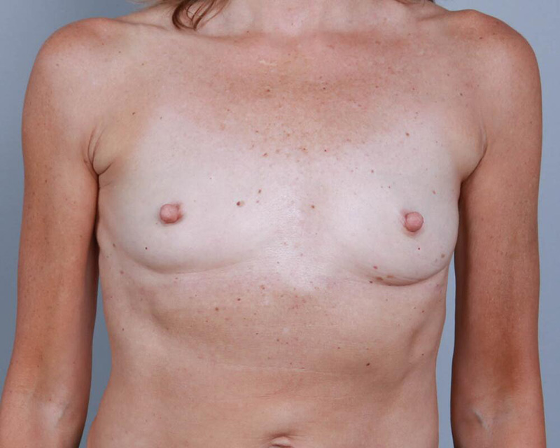 Breast Augmentation Before & After Image