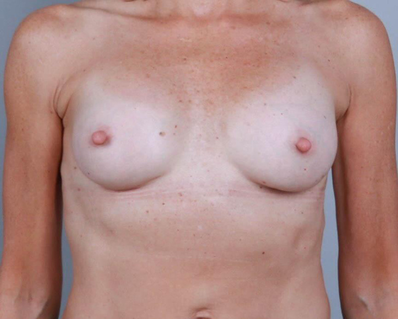 Breast Augmentation Before & After Image