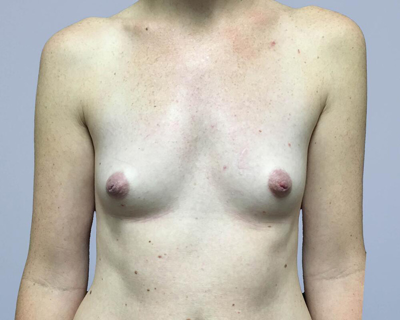 Breast Augmentation Before & After Image