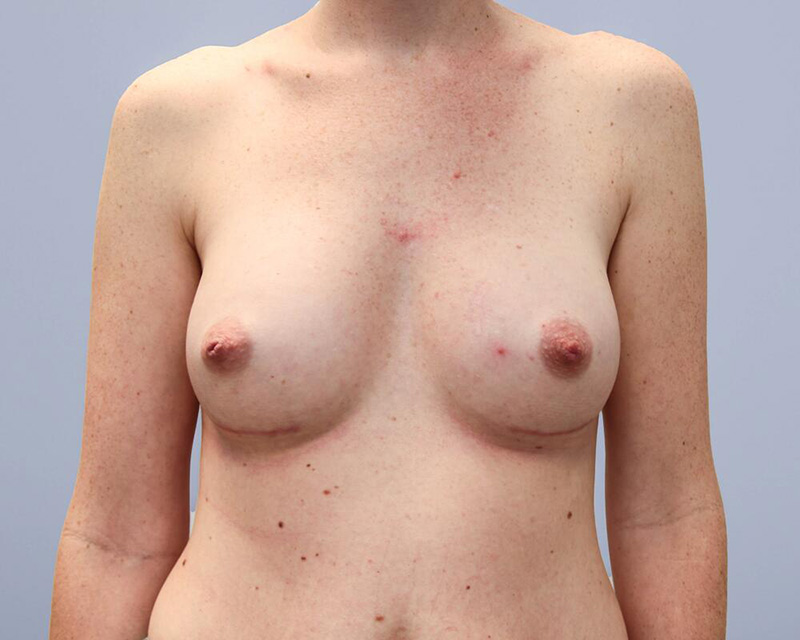 Breast Augmentation Before & After Image