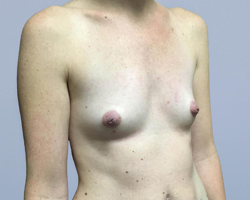 Breast Augmentation Before & After Image