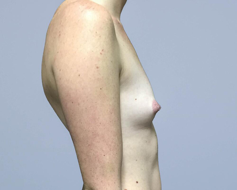 Breast Augmentation Before & After Image