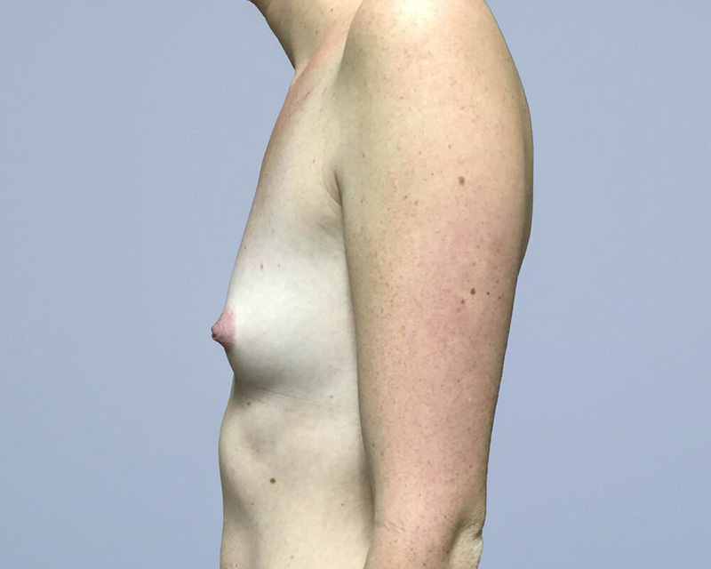 Breast Augmentation Before & After Image