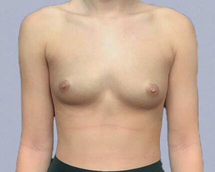 Breast Augmentation Before & After Image