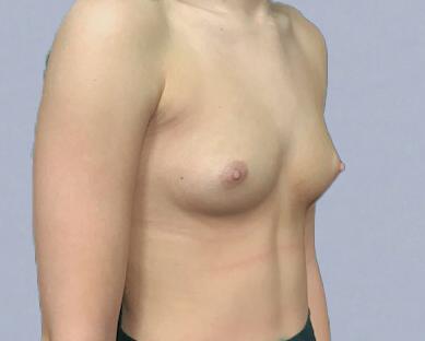 Breast Augmentation Before & After Image