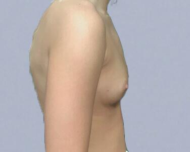 Breast Augmentation Before & After Image