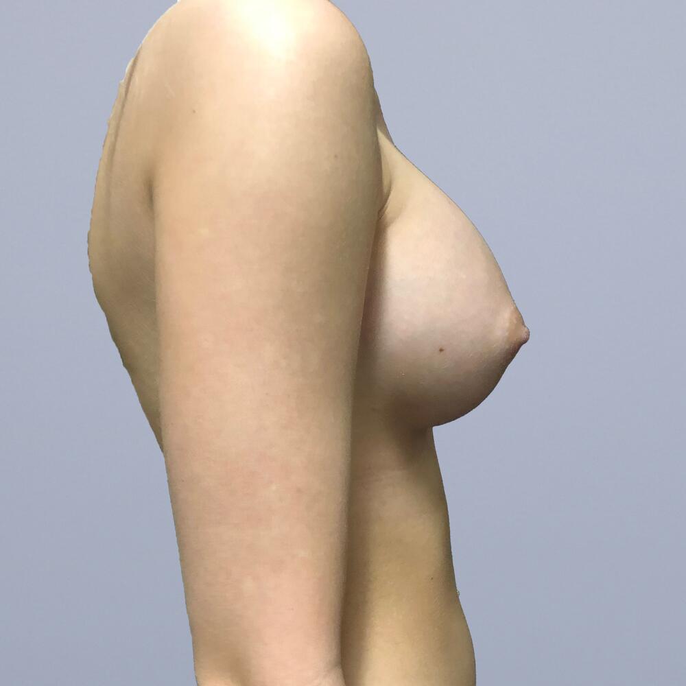 Breast Augmentation Before & After Image