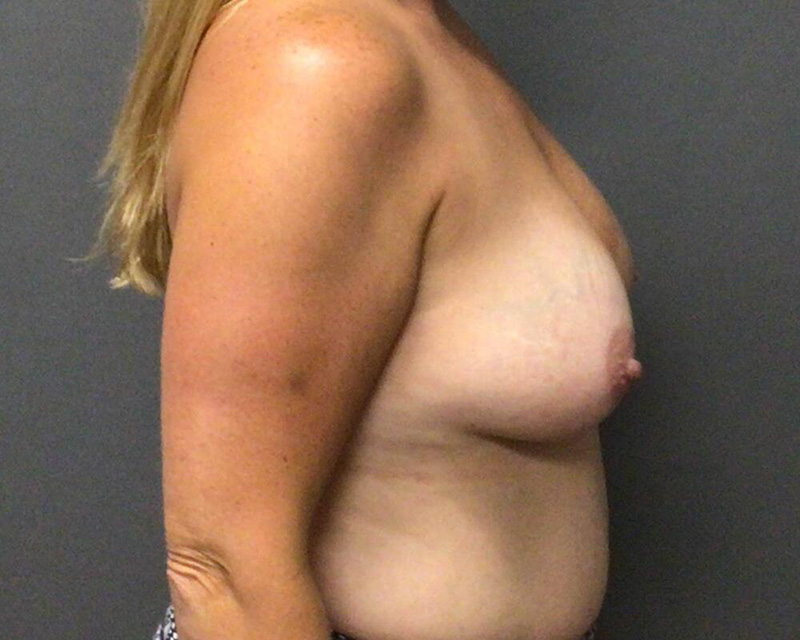 Breast Augmentation Before & After Image