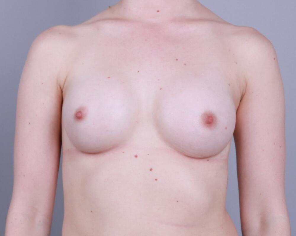 Breast Augmentation Before & After Image