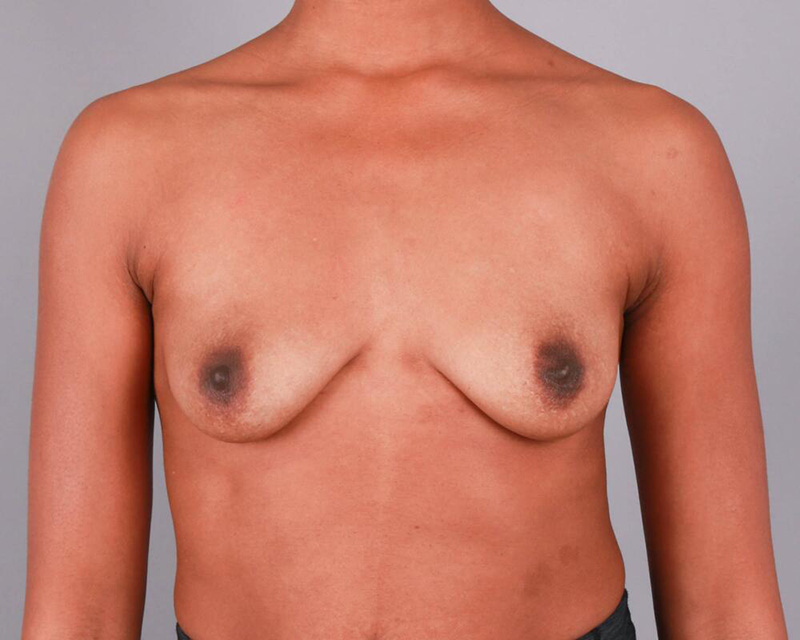 Breast Augmentation Before & After Image