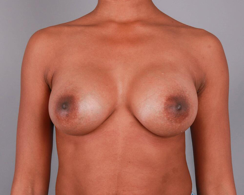 Breast Augmentation Before & After Image