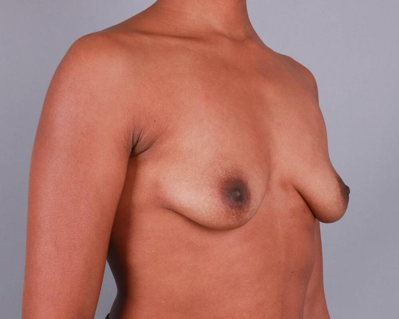 Breast Augmentation Before & After Image