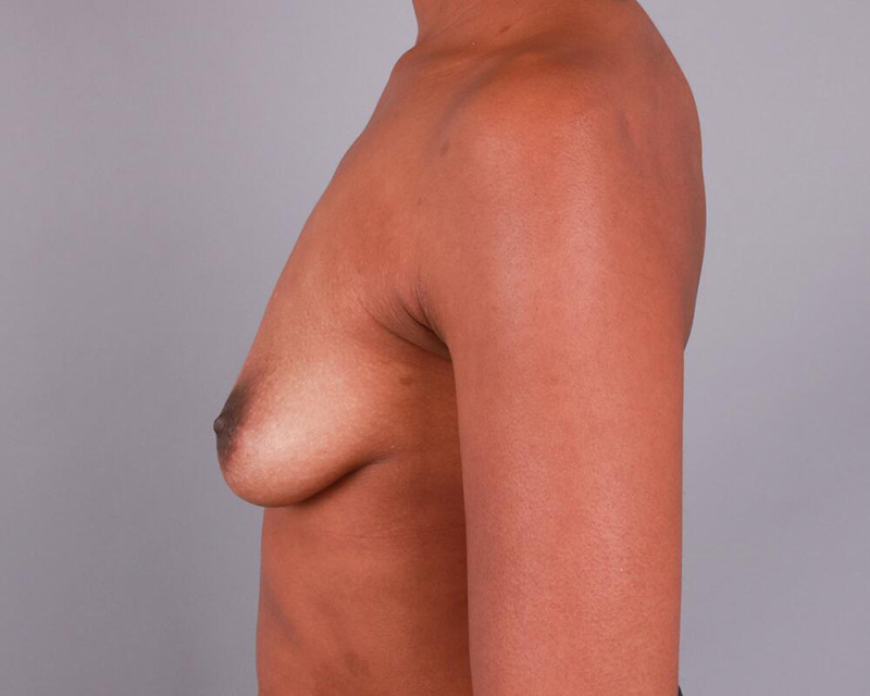 Breast Augmentation Before & After Image