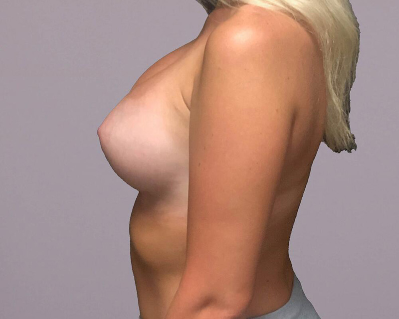 Breast Augmentation Before & After Image