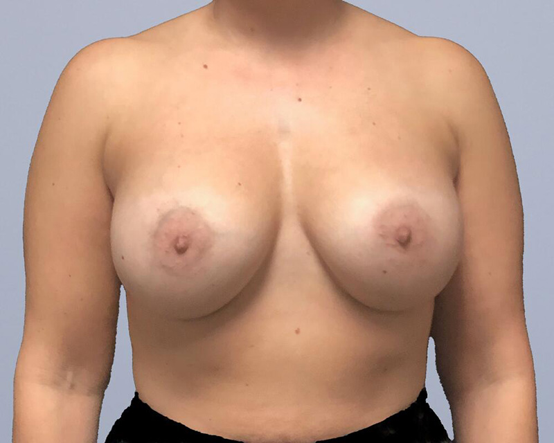 Breast Augmentation Before & After Image