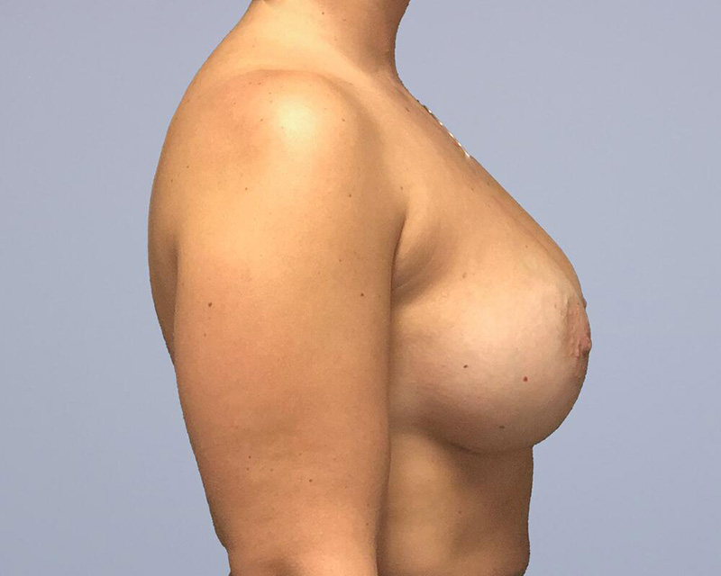 Breast Augmentation Before & After Image