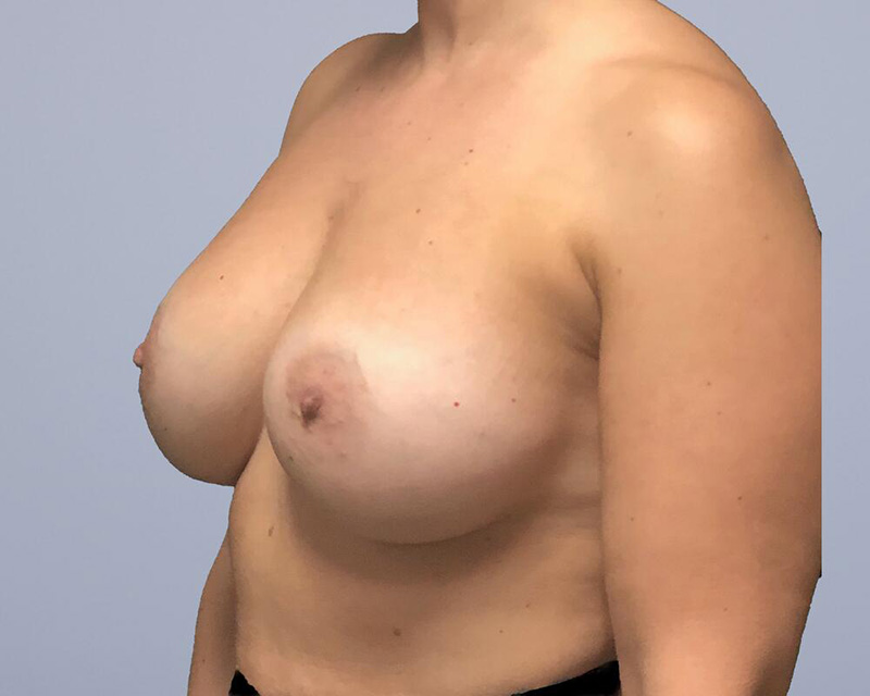 Breast Augmentation Before & After Image