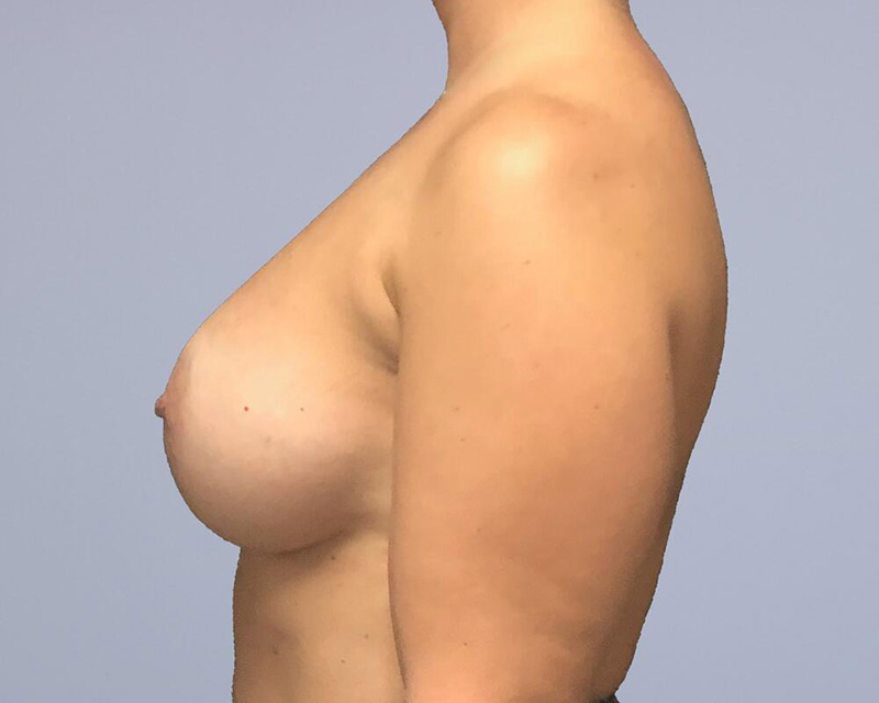 Breast Augmentation Before & After Image