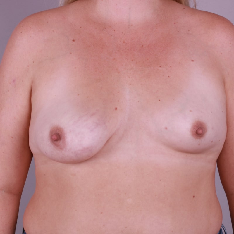 Breast Augmentation Before & After Image