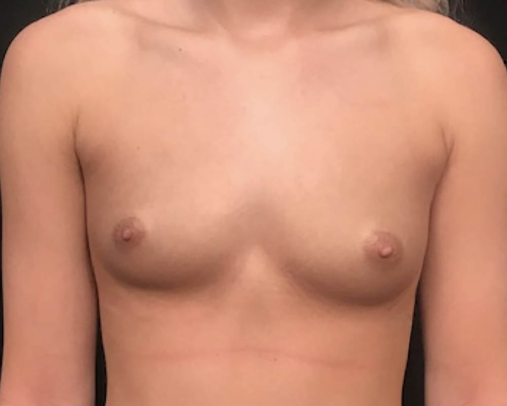 Breast Augmentation Before & After Image