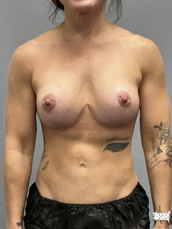 Breast Implant Exchange Before & After Image