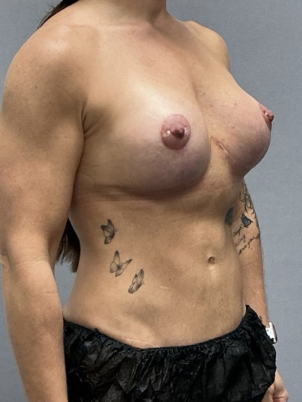 Breast Implant Exchange Before & After Image
