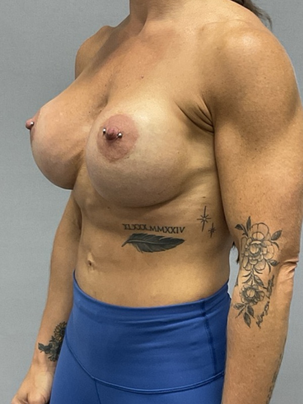 Breast Implant Exchange Before & After Image