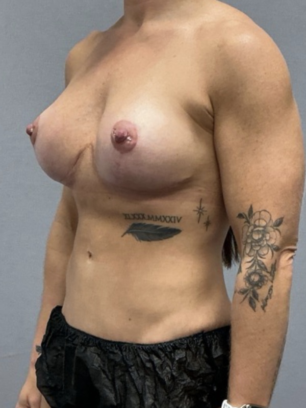 Breast Implant Exchange Before & After Image