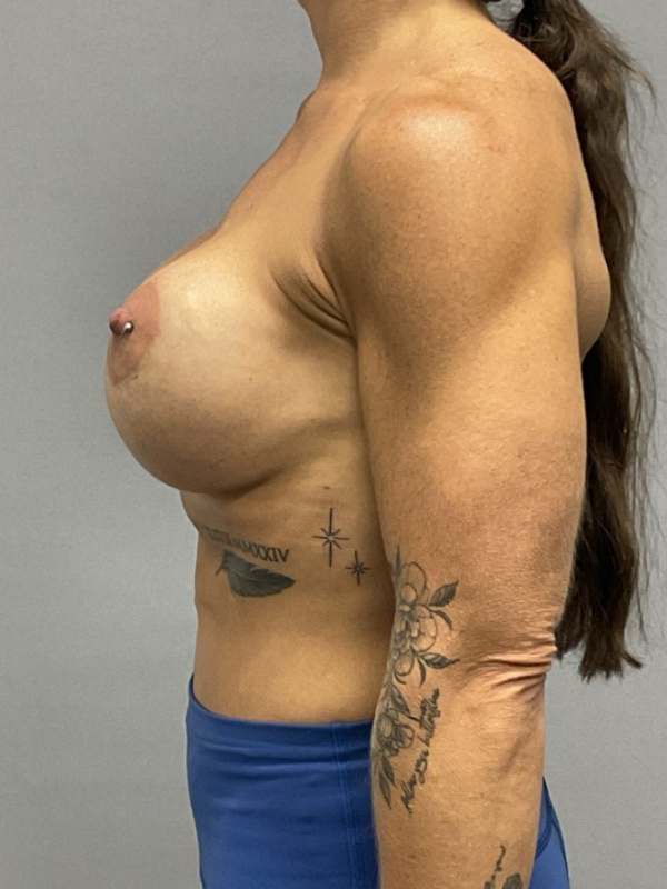 Breast Implant Exchange Before & After Image