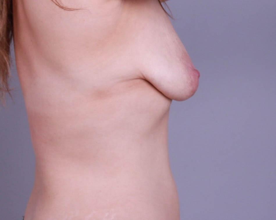 Breast Lift With Implants Before & After Image