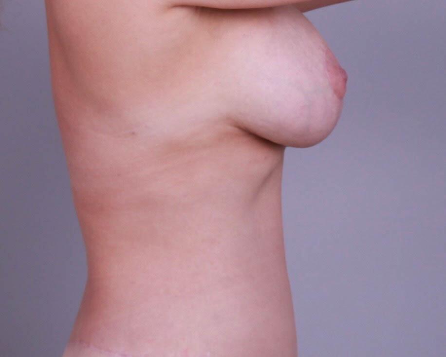 Breast Lift With Implants Before & After Image