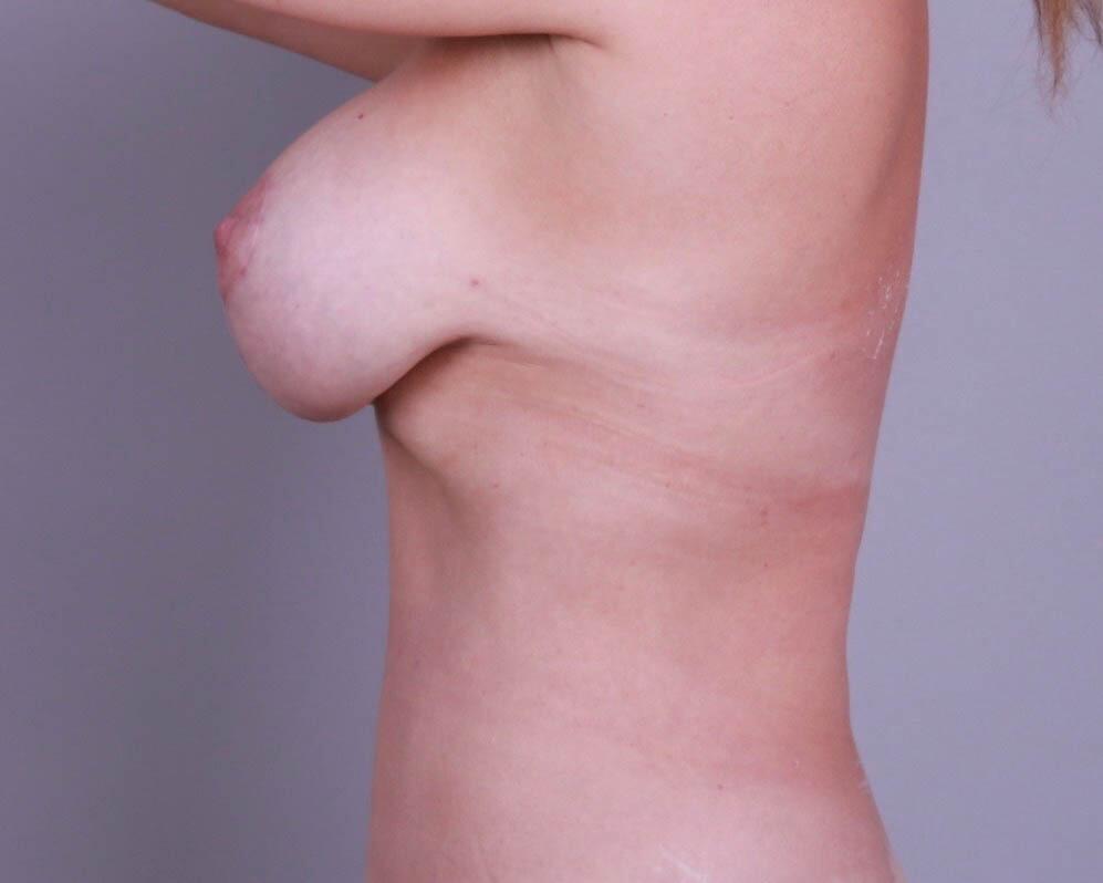 Breast Lift With Implants Before & After Image