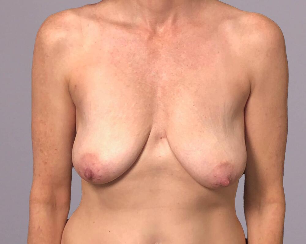 Breast Lift With Implants Before & After Image