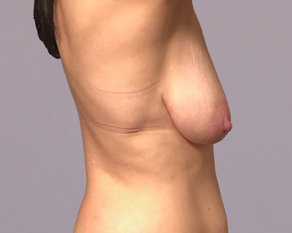 Breast Lift With Implants Before & After Image